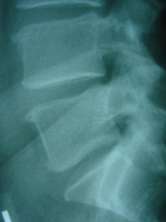 xray of spine